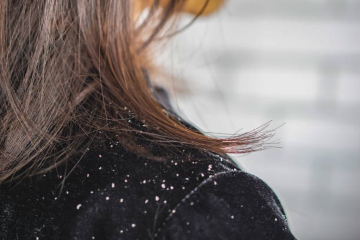 dandruff