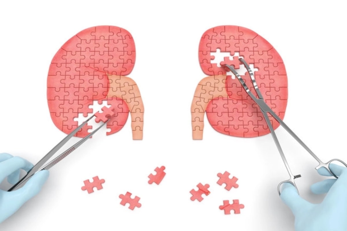 Kidney Transplant: A Hope For People With Kidney Failure